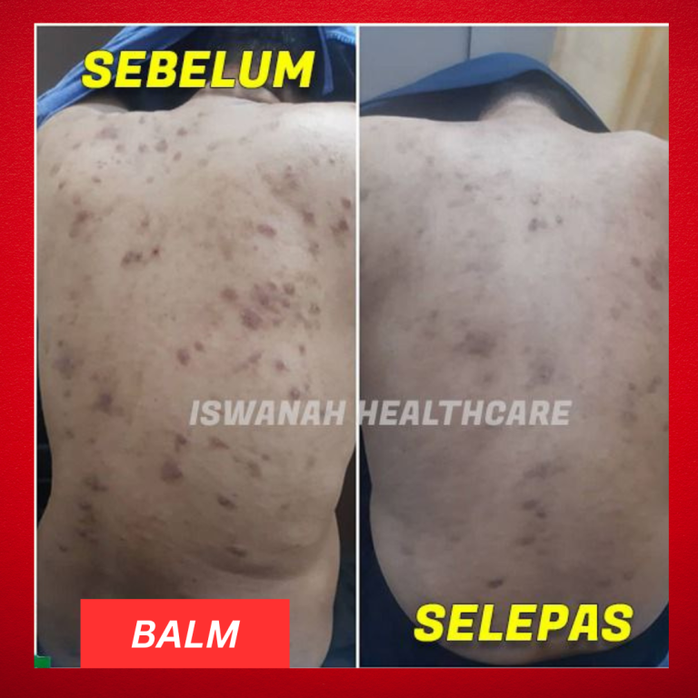 rawatan psoriasis sembuh