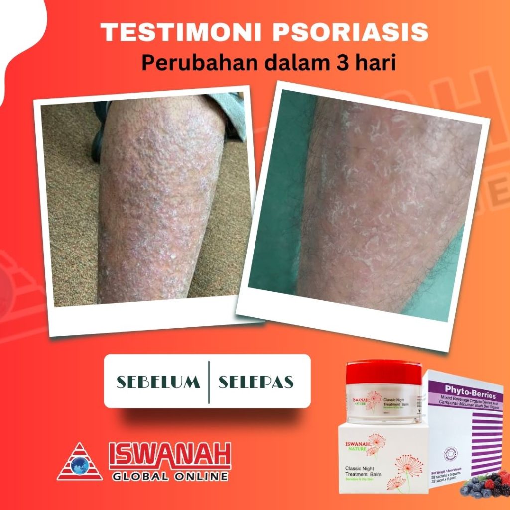 rawatan psoriasis