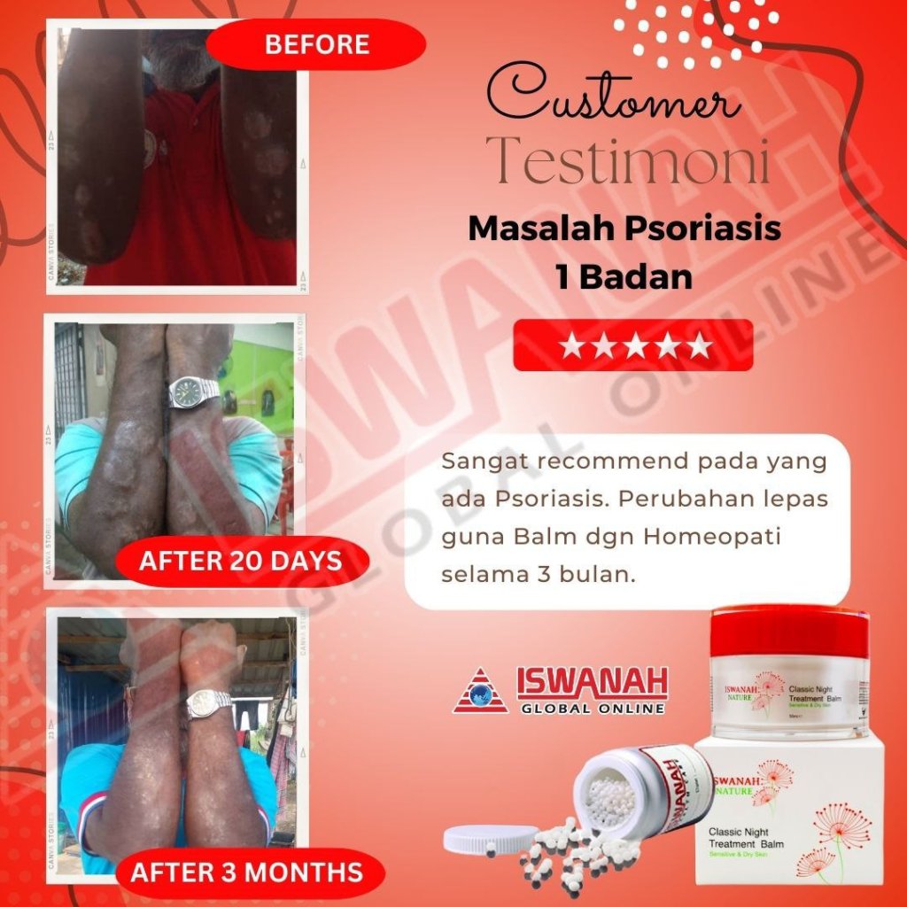 ubat psoriasis